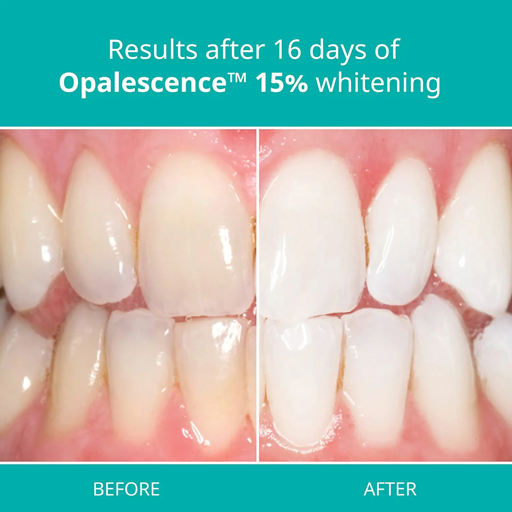 Профессиональный набор для отб – обзор и цена Teeth Whitening Gel Opalescence