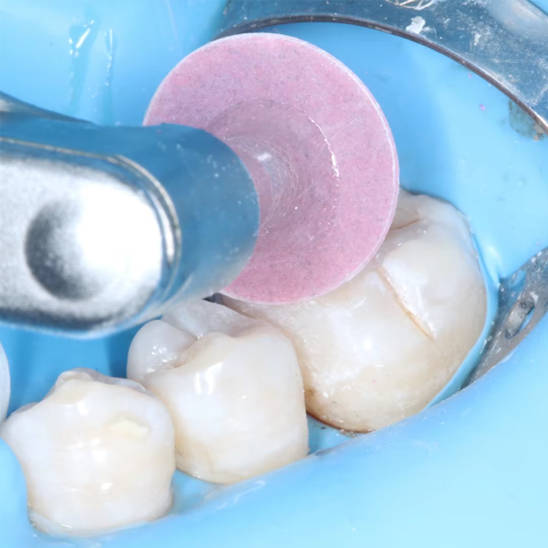 40 шт. стоматологических полир – обзор и цена Teeth Whitening Express