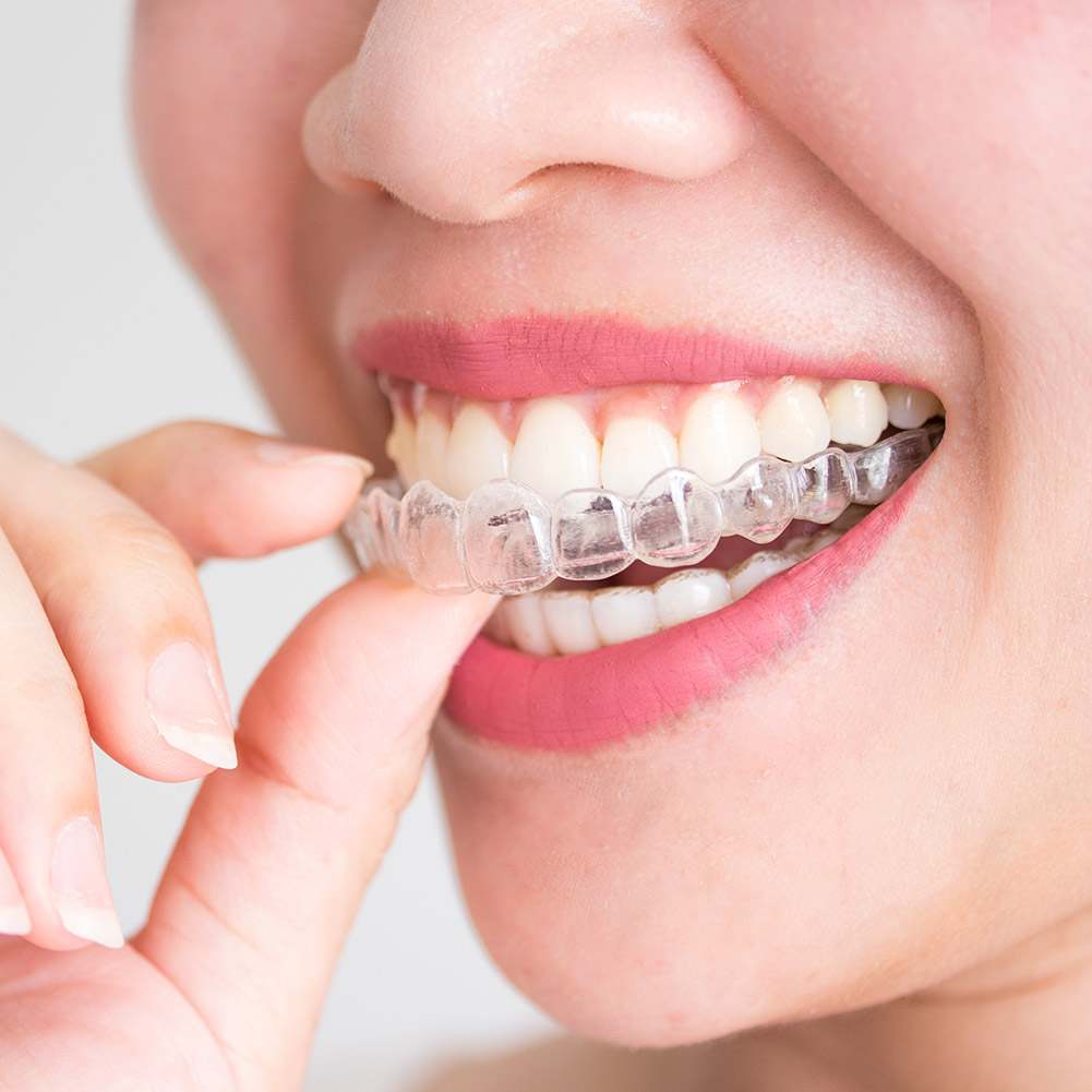 Набор профессиональных ортодон – обзор и цена Teeth Whitening For Trays