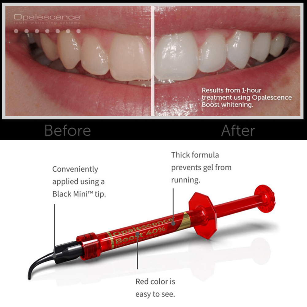 Гель для отбеливания зубов Ult – обзор и цена Teeth Whitening Gel Opalescence